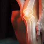Understanding Bone TI